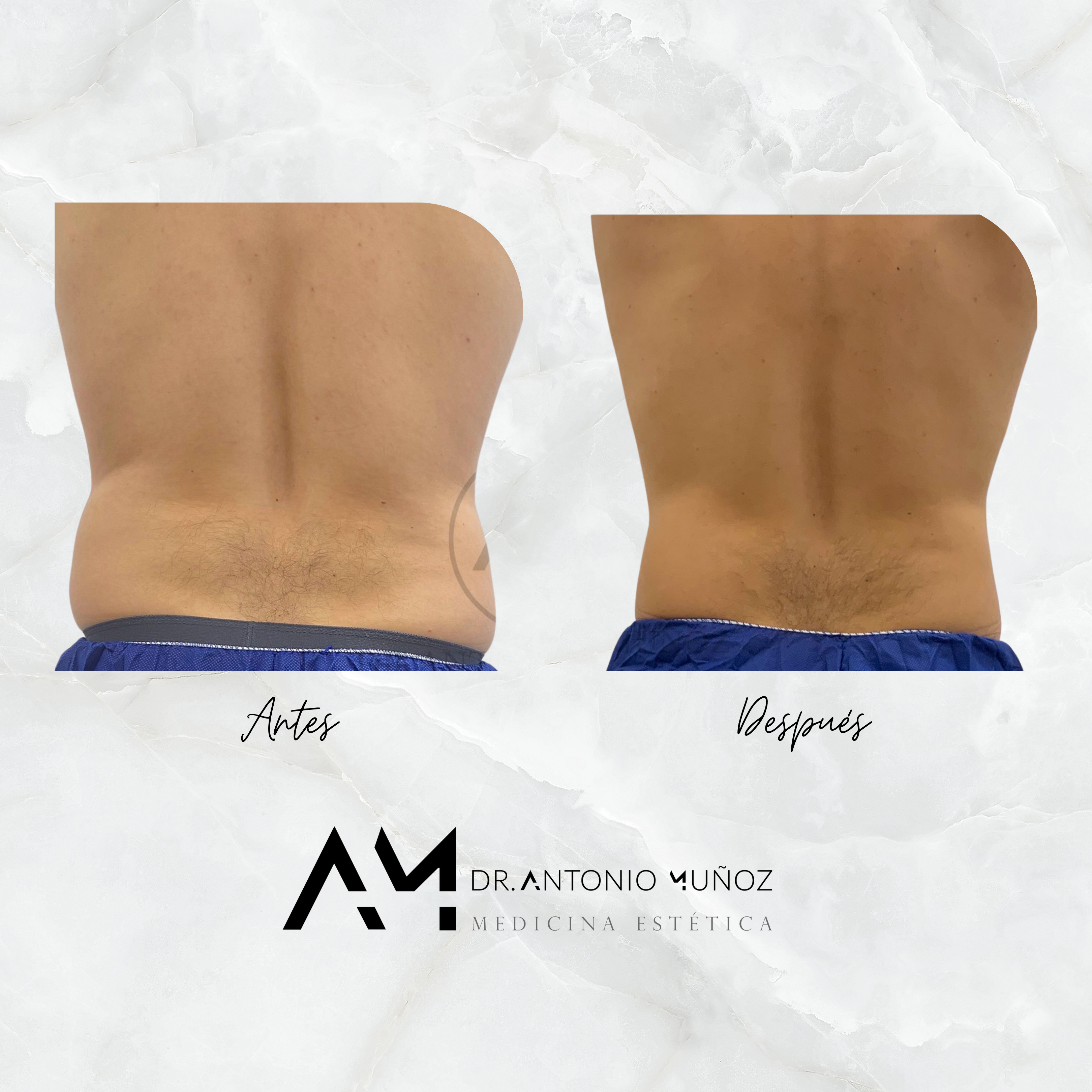 Coolsculpting