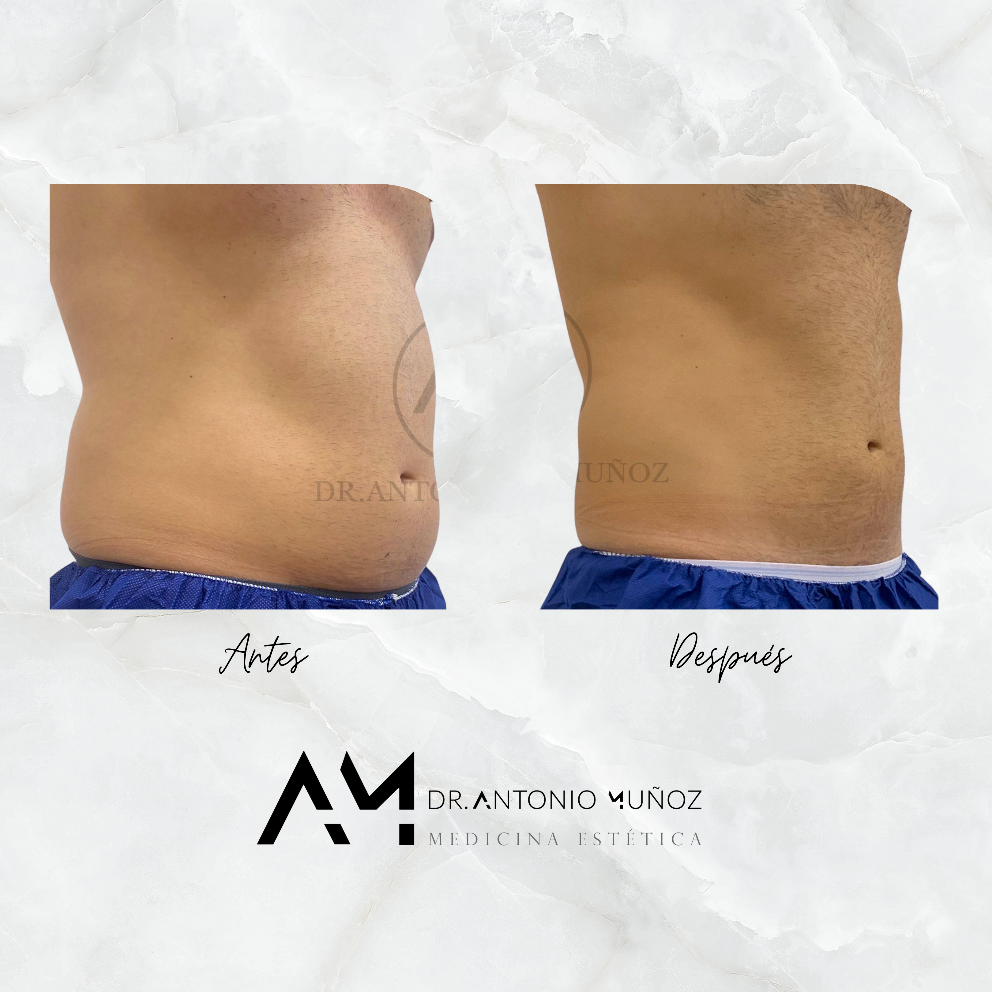 Coolsculpting
