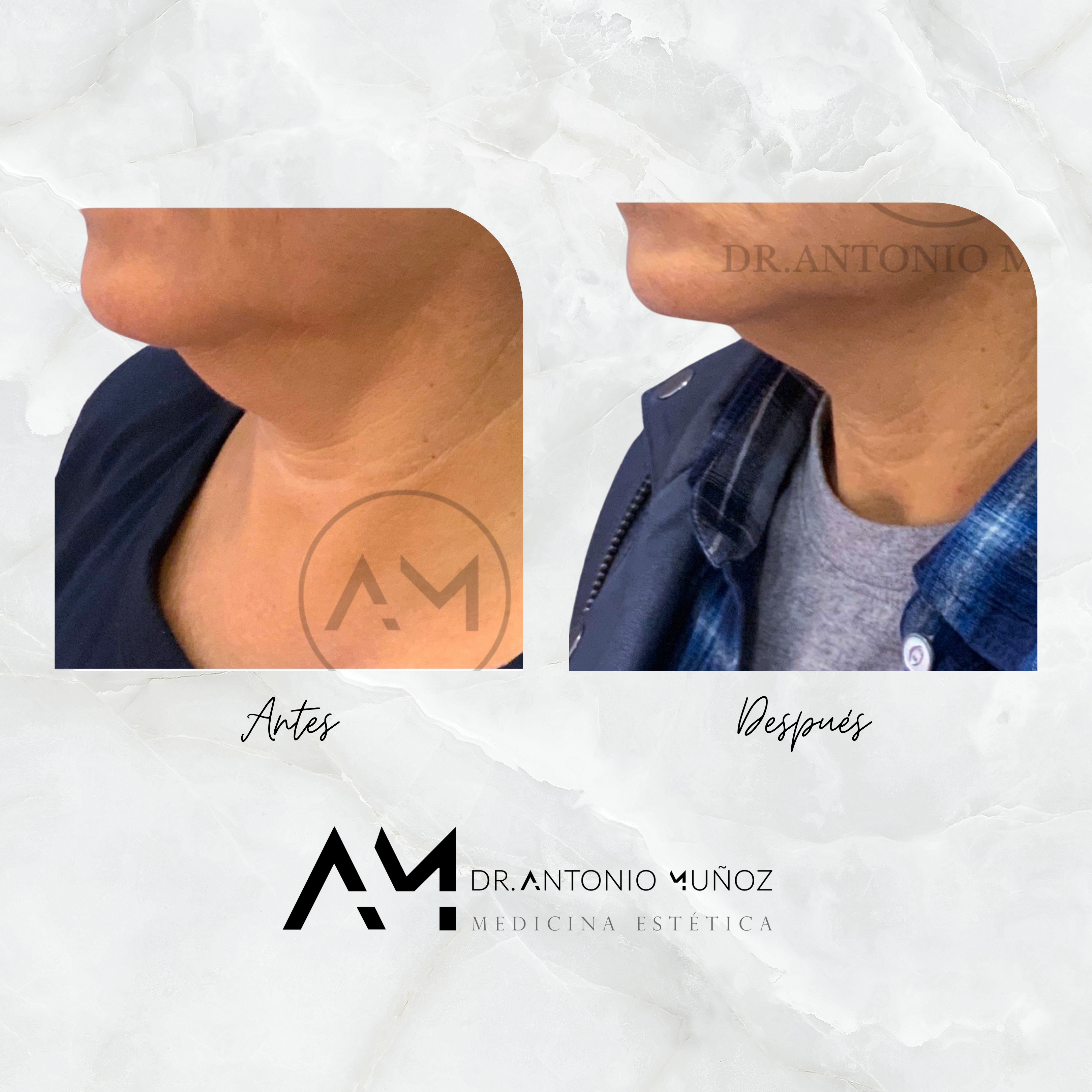 Coolsculpting