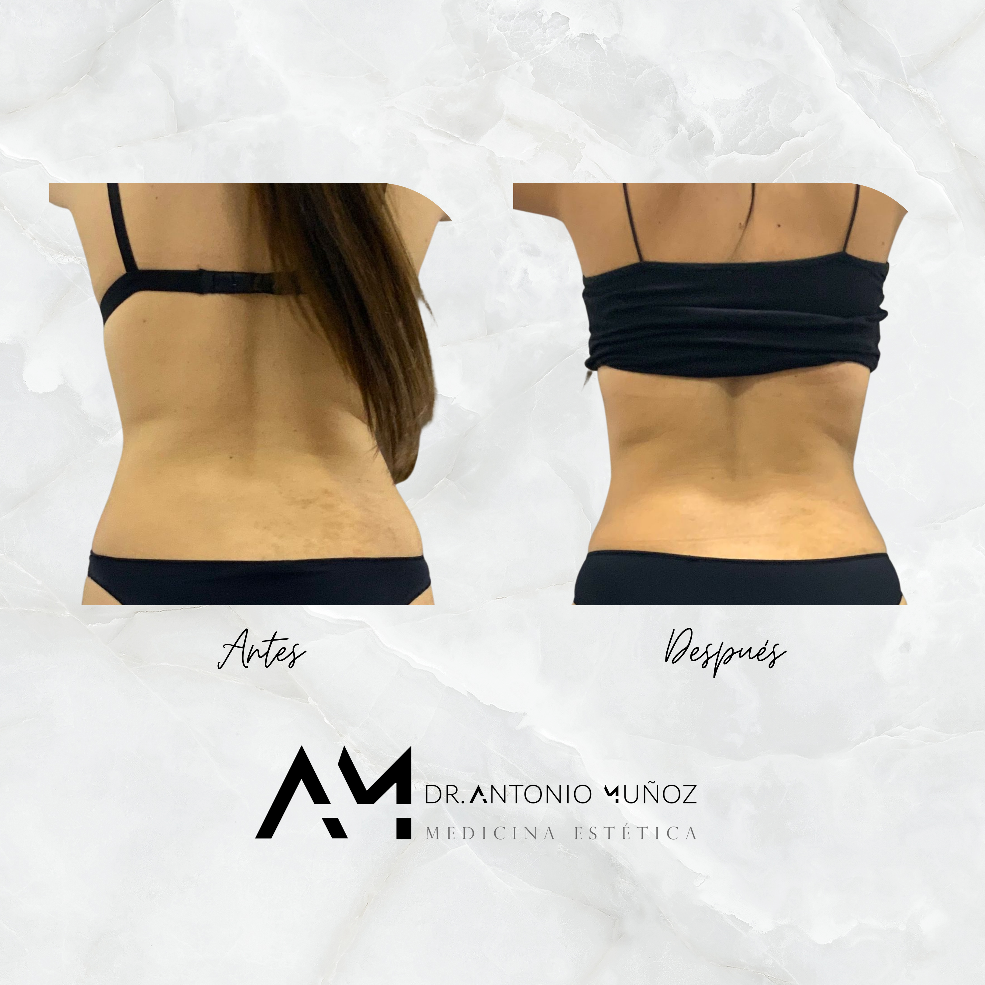 Coolsculpting