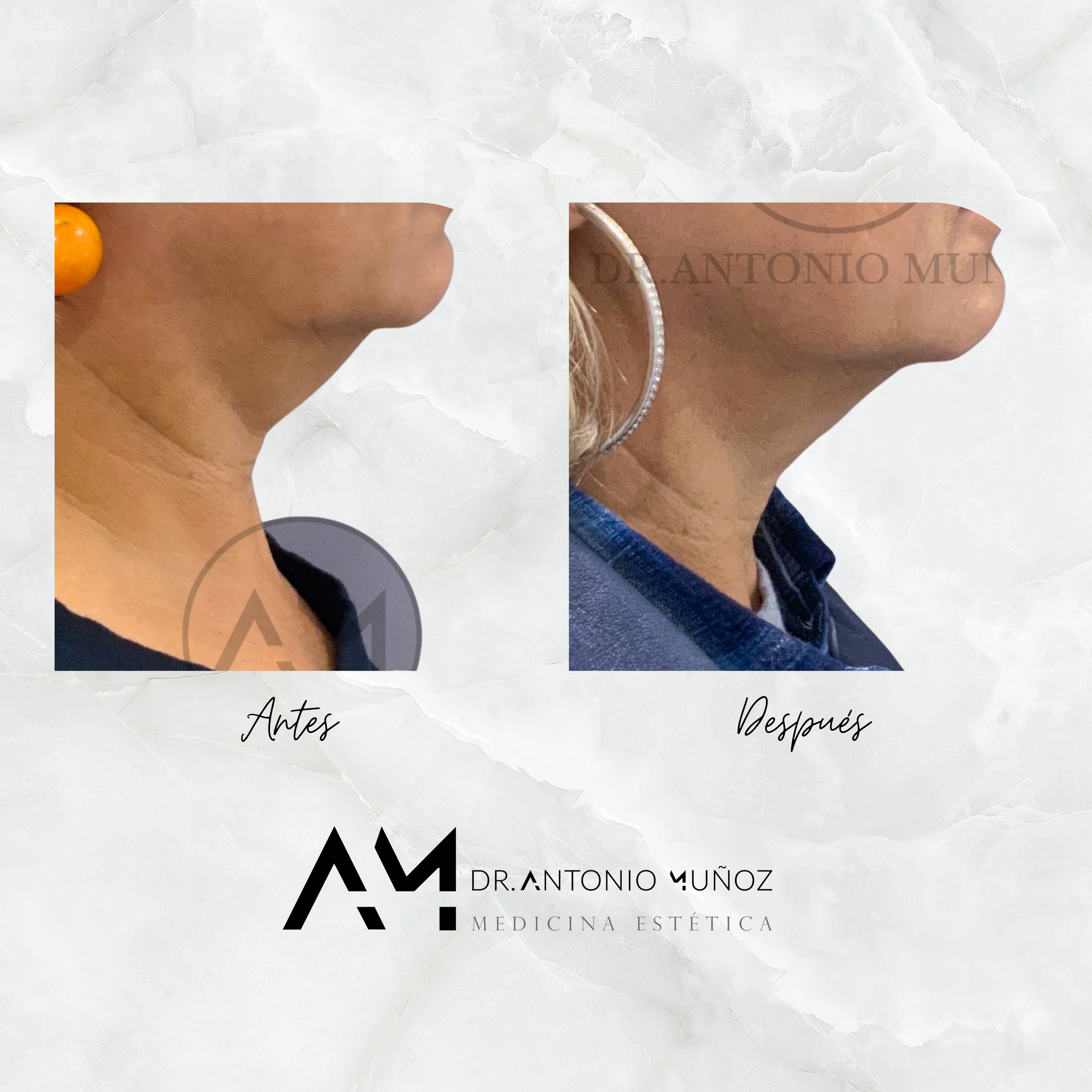 Coolsculpting