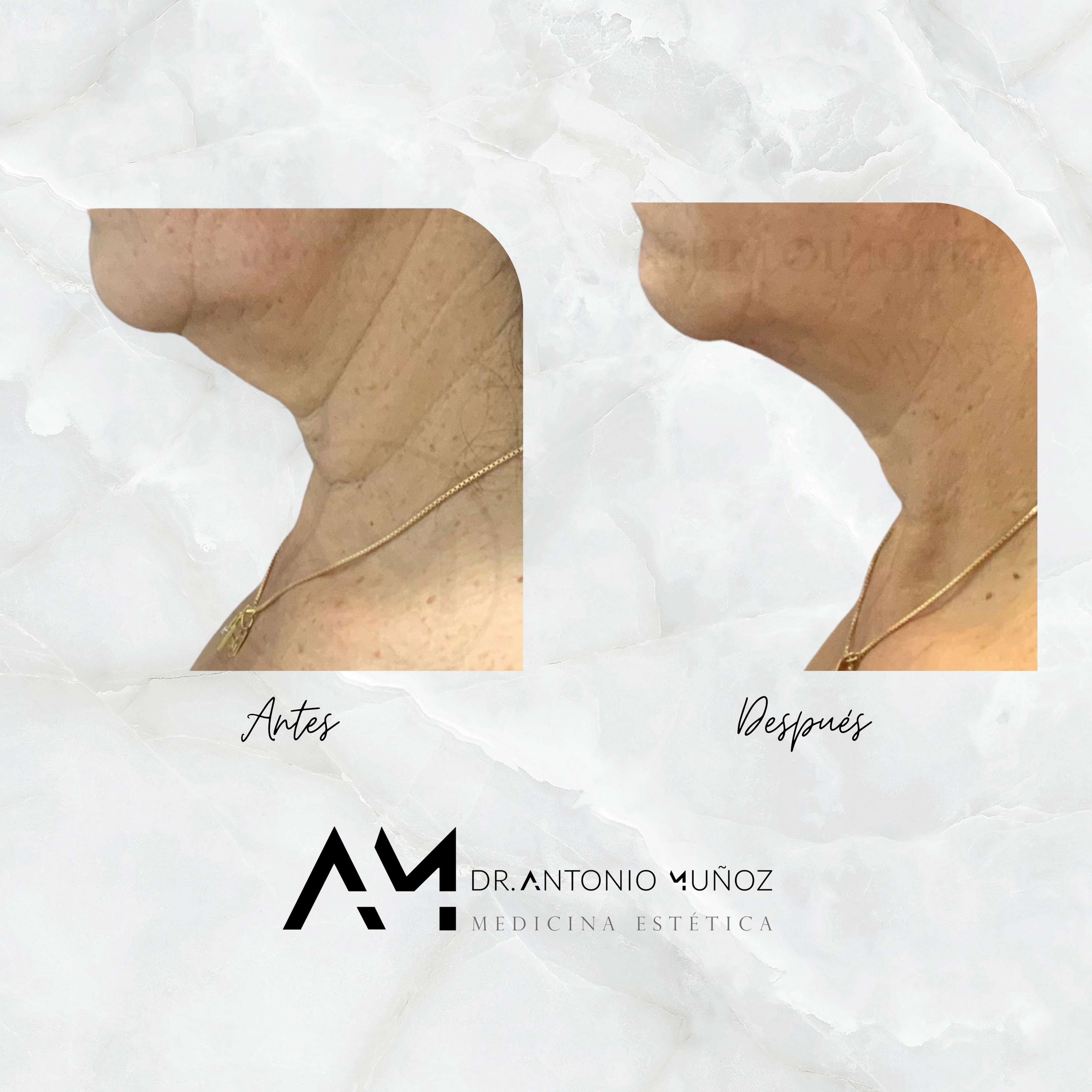 Coolsculpting
