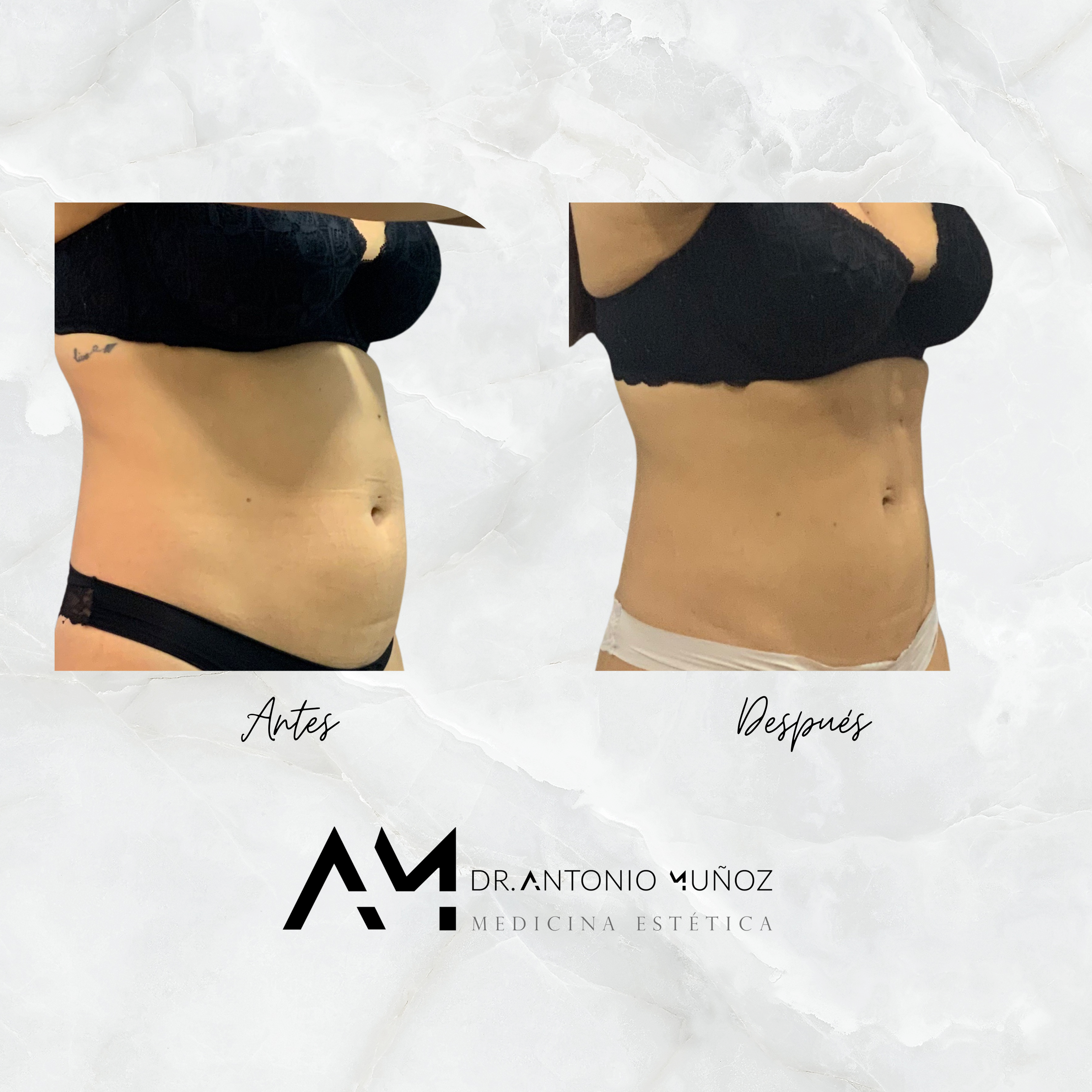 Coolsculpting