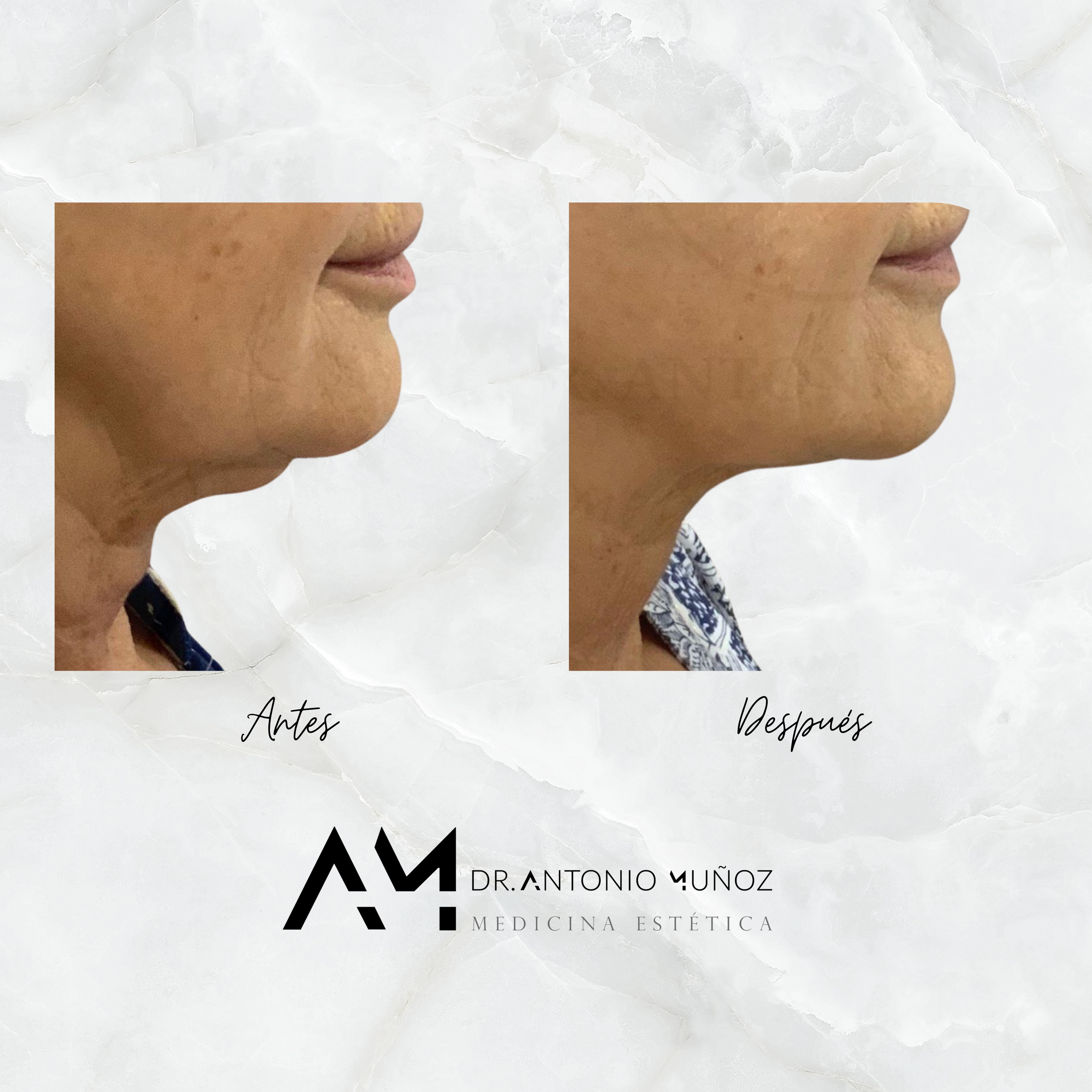 Coolsculpting
