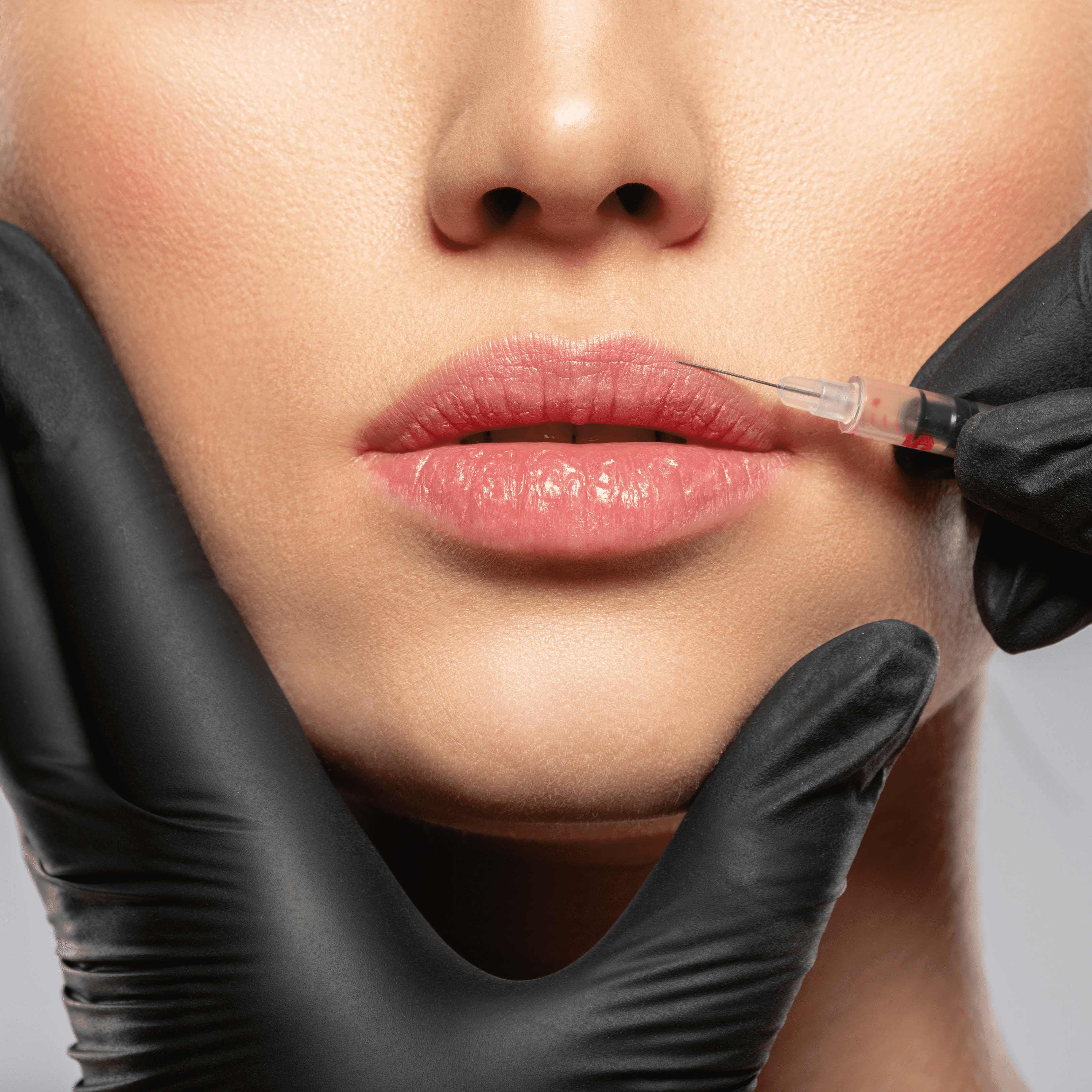 aumento de labios en Alicante