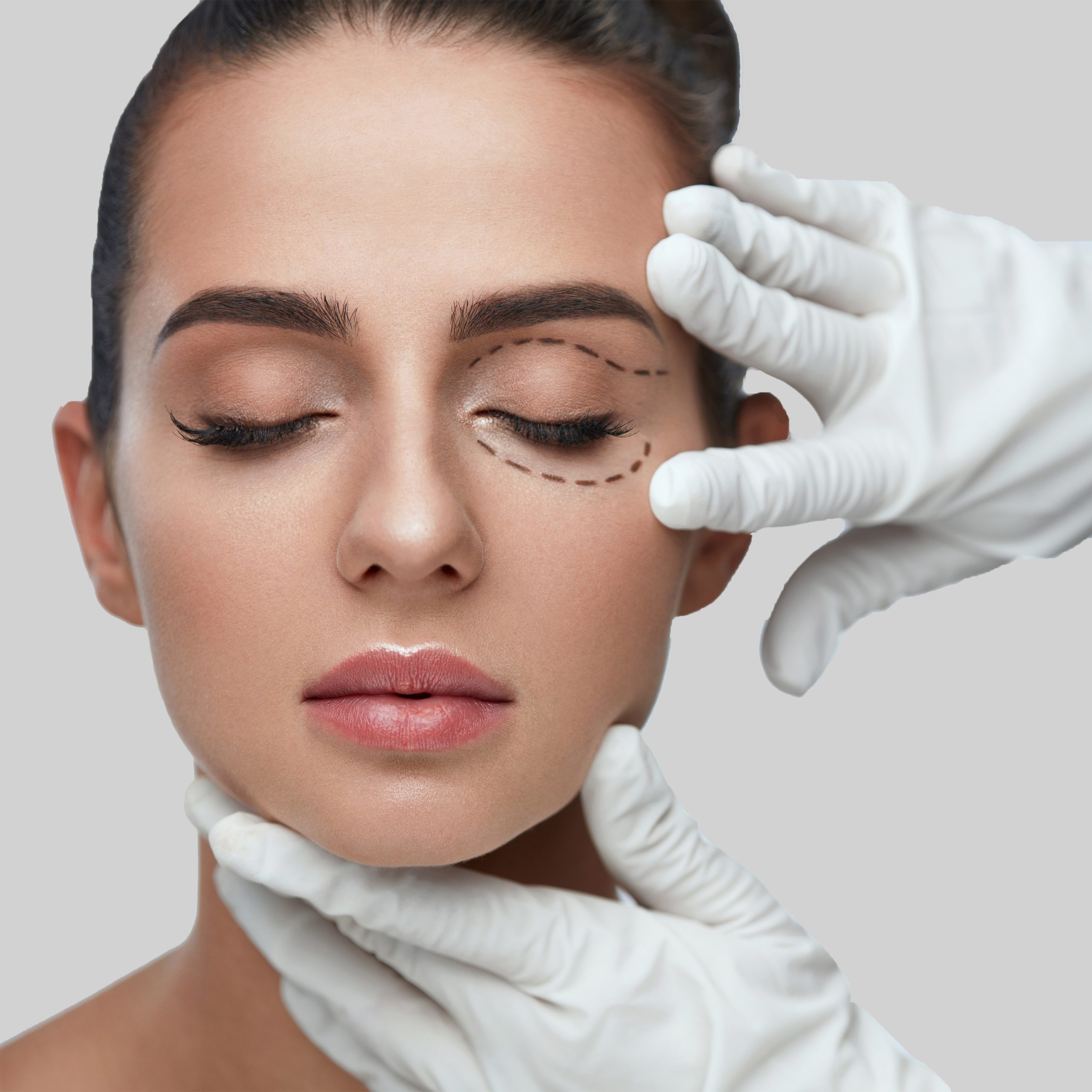 Blefaroplastia sin cirugía en Alicante