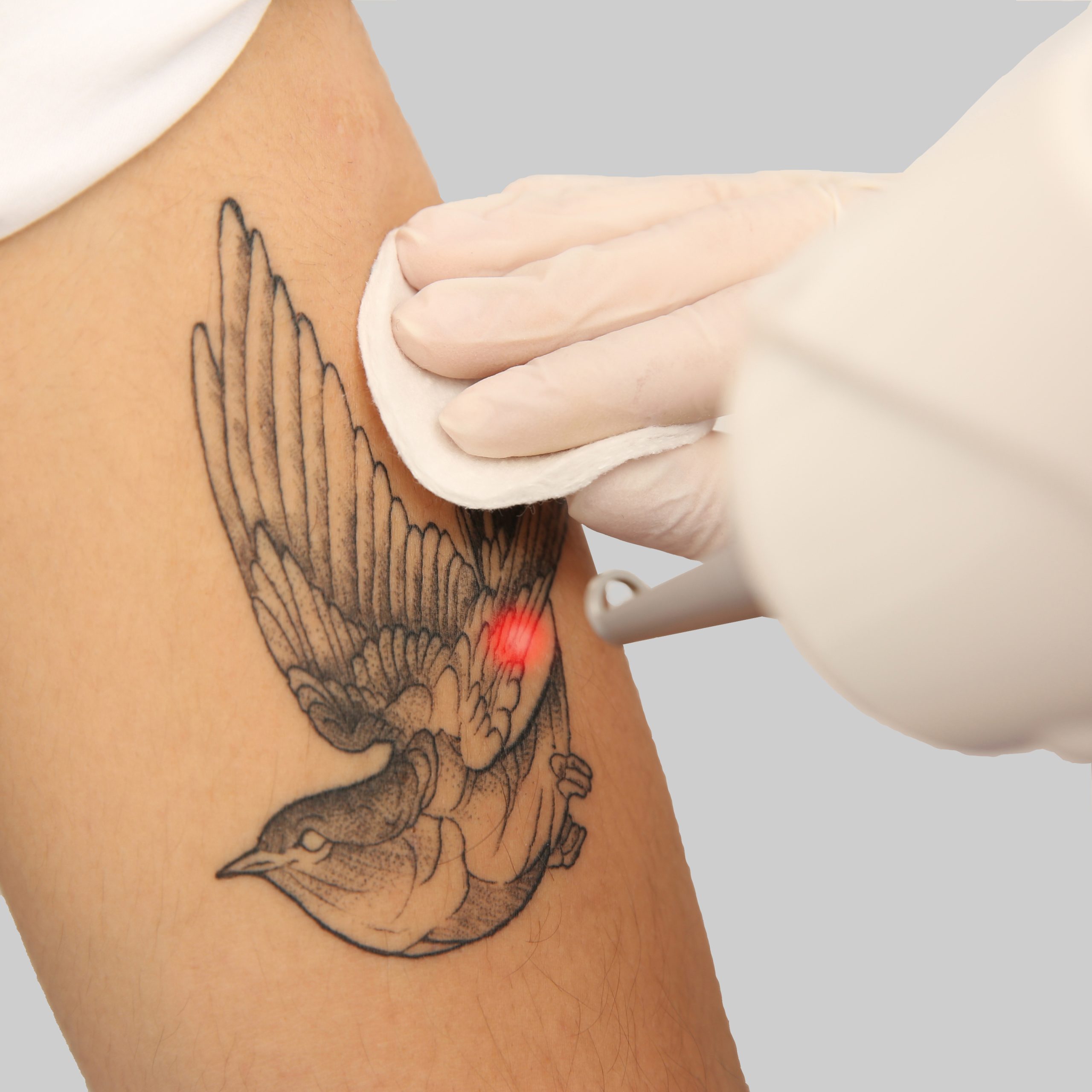 eliminación de tatuajes en Alicante