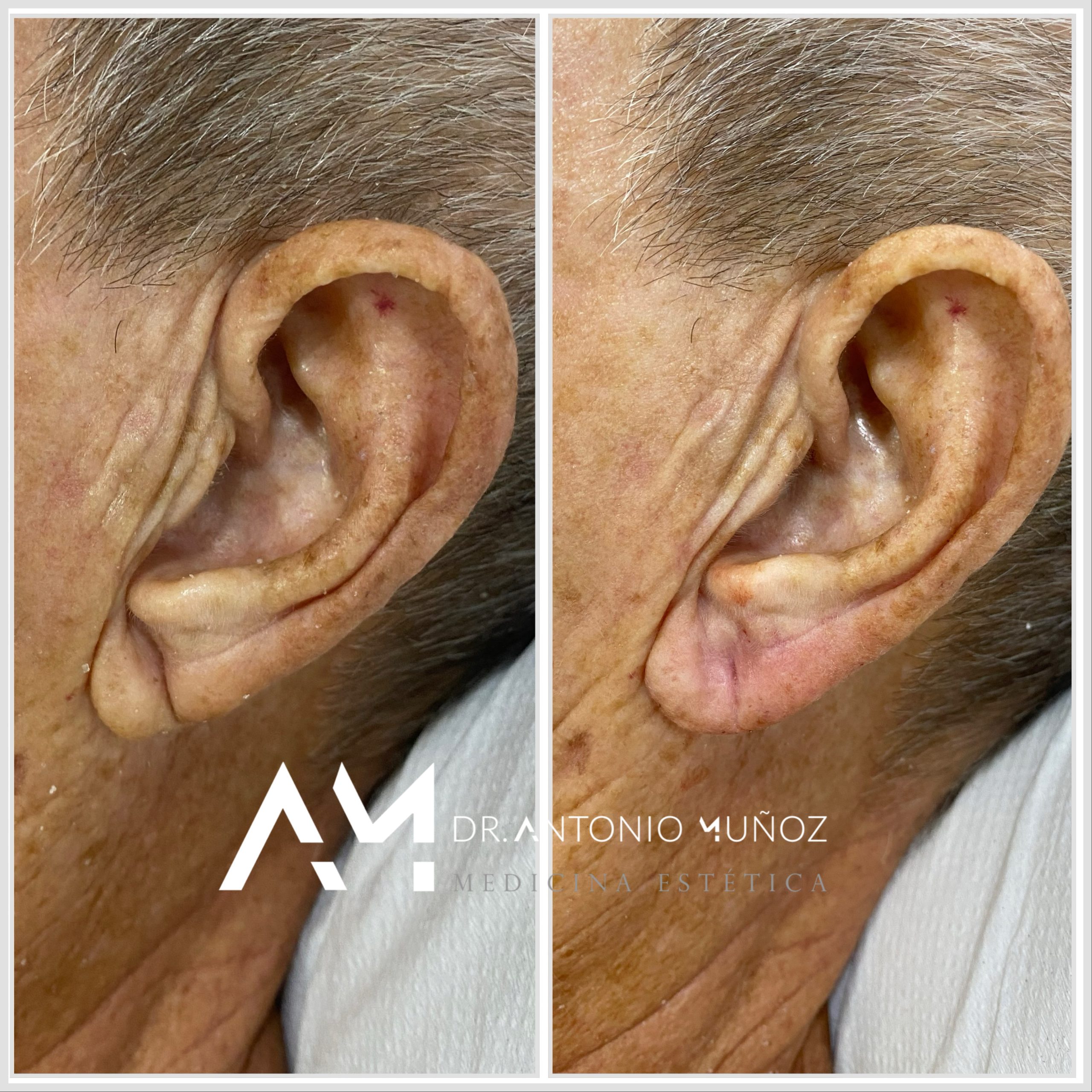 tratamiento lóbulo de la oreja