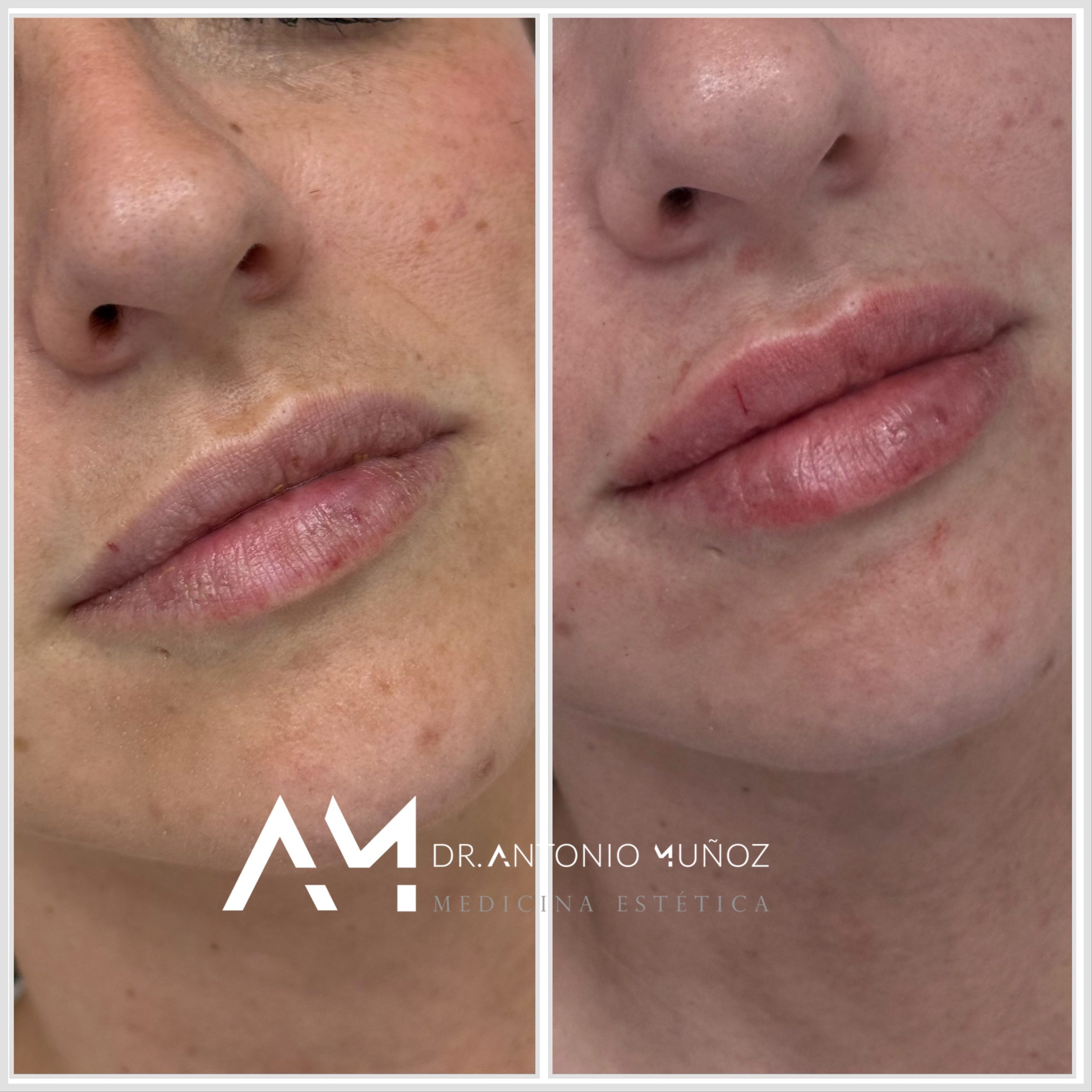 aumento de labios