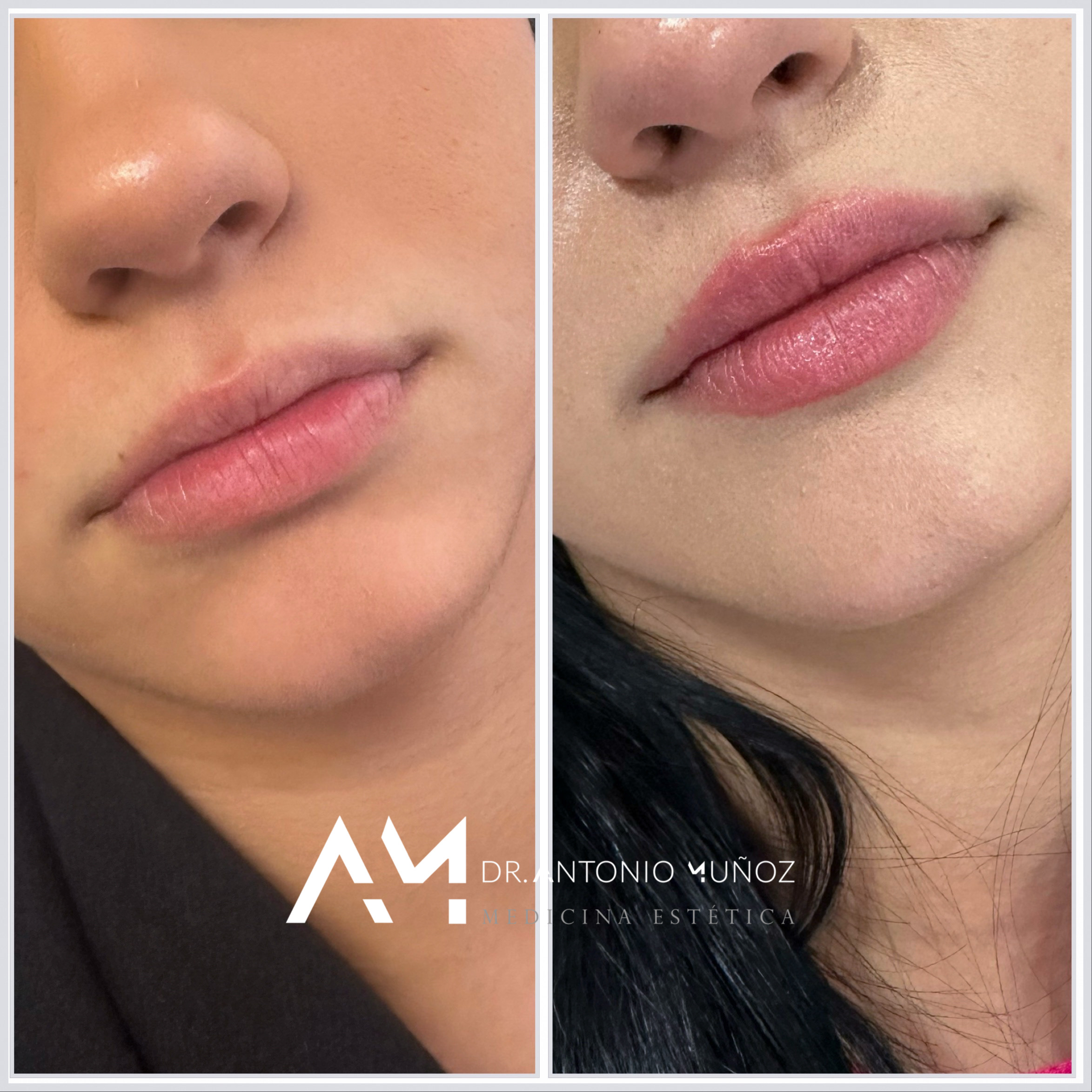aumento de labios