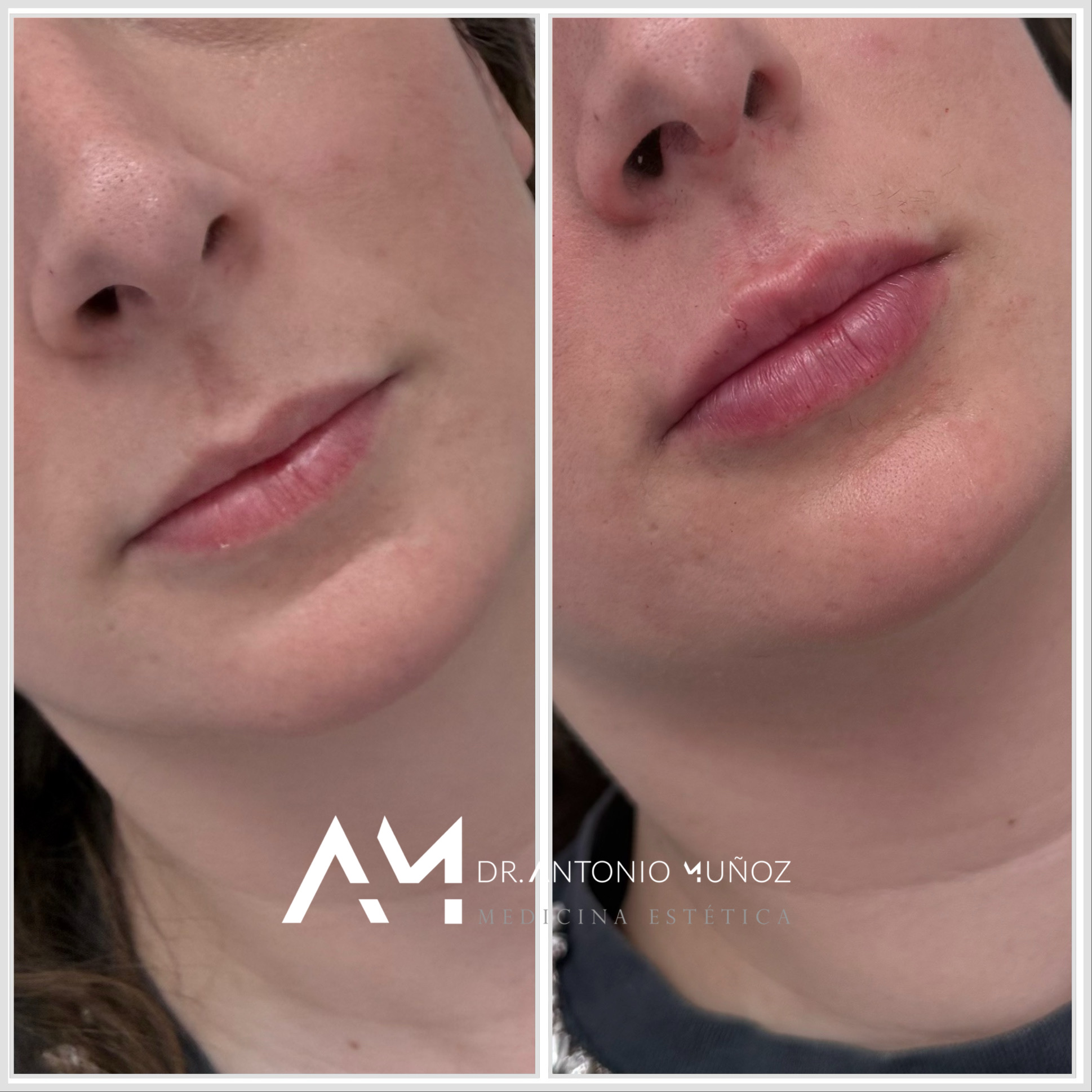 aumento de labios