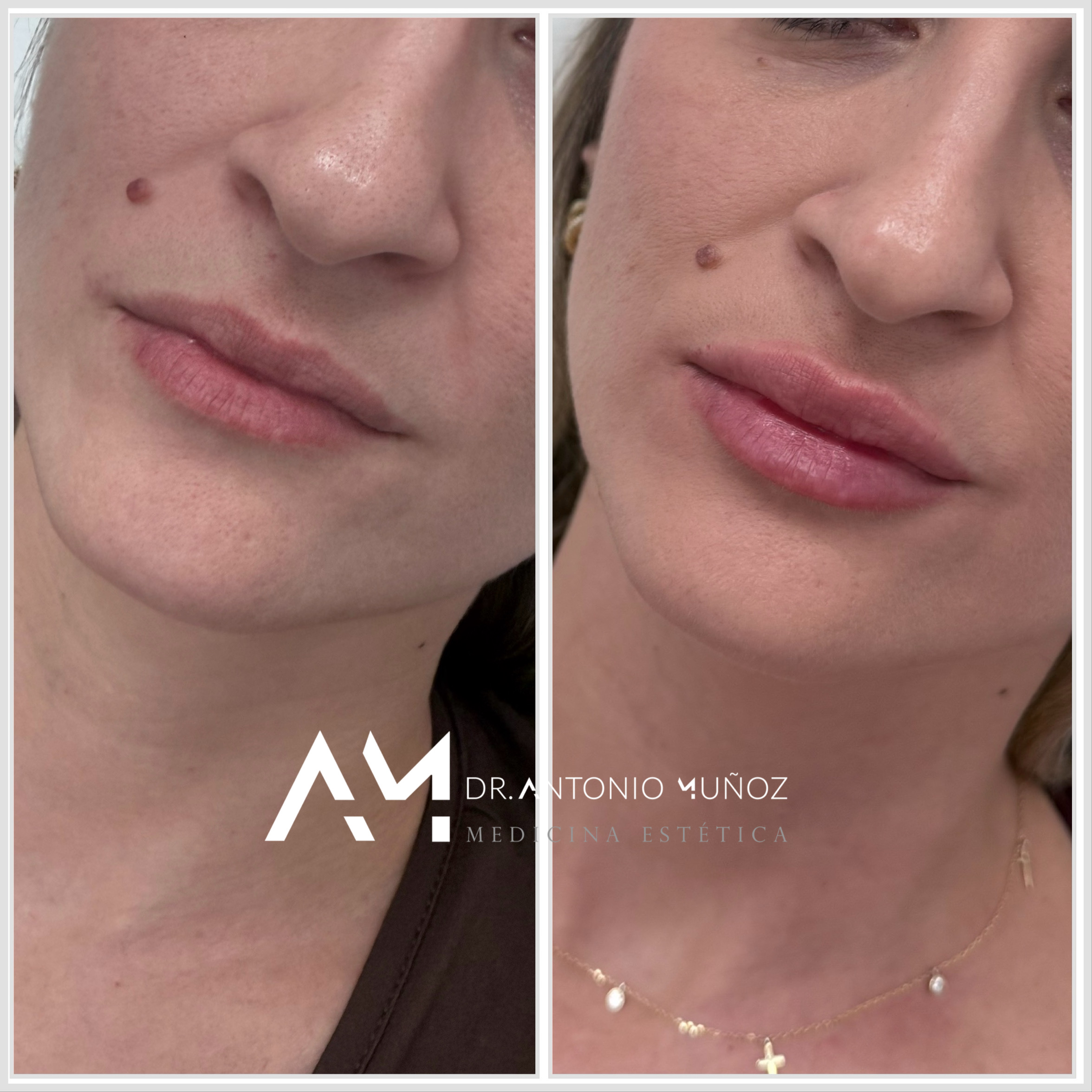 aumento de labios