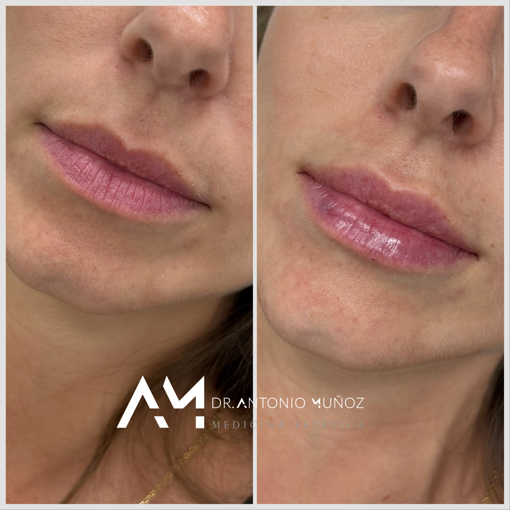 aumento de labios