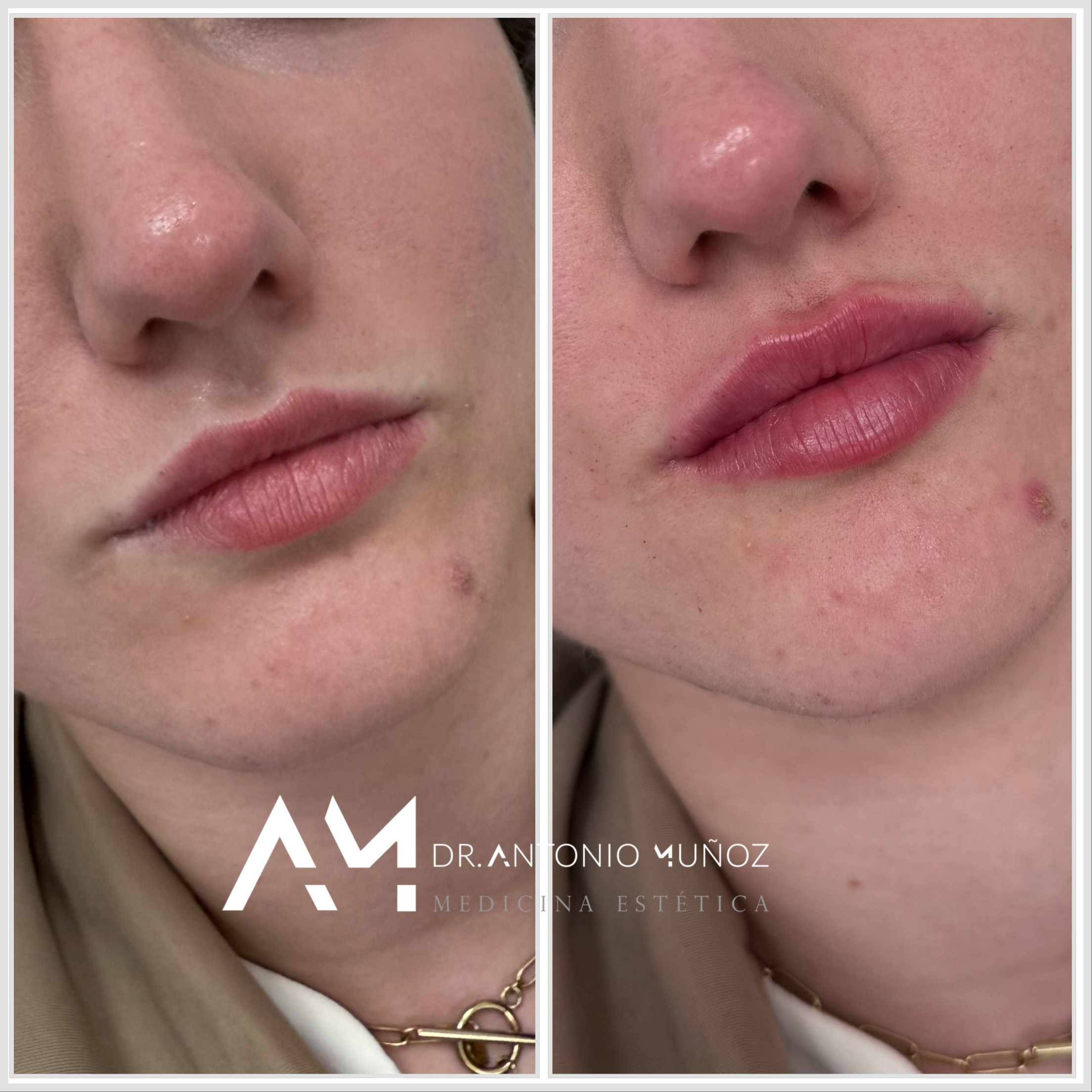 aumento de labios