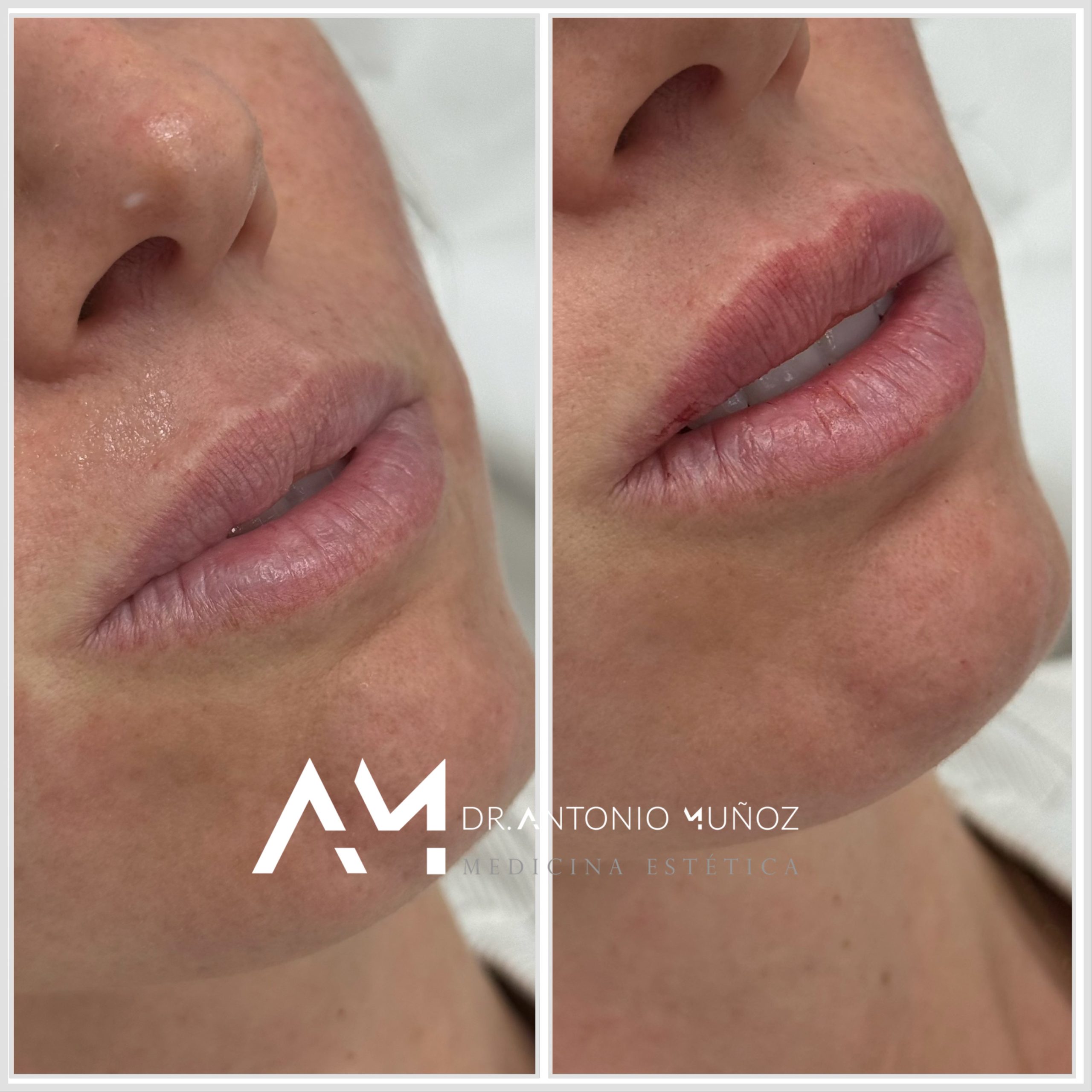 aumento de labios