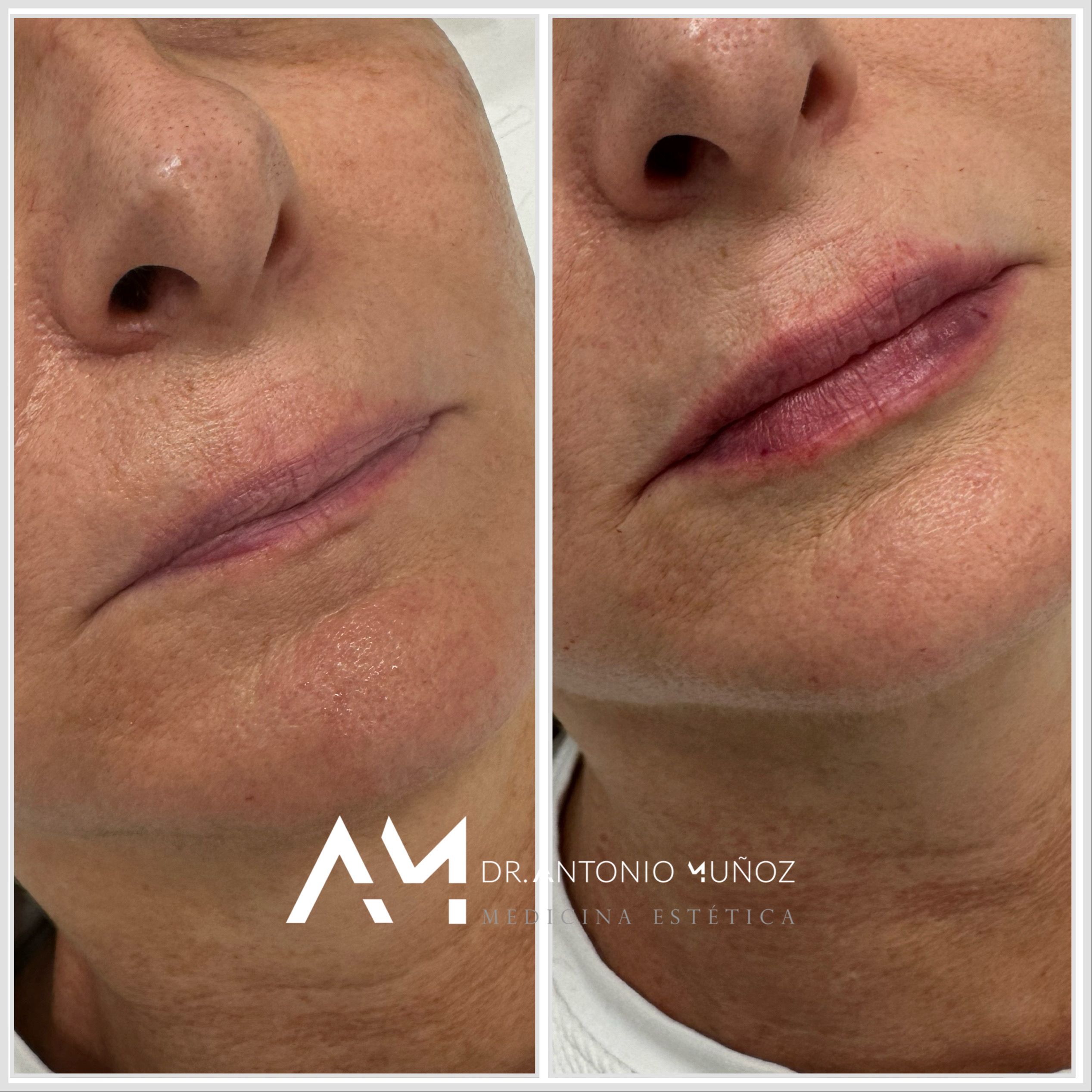 aumento de labios