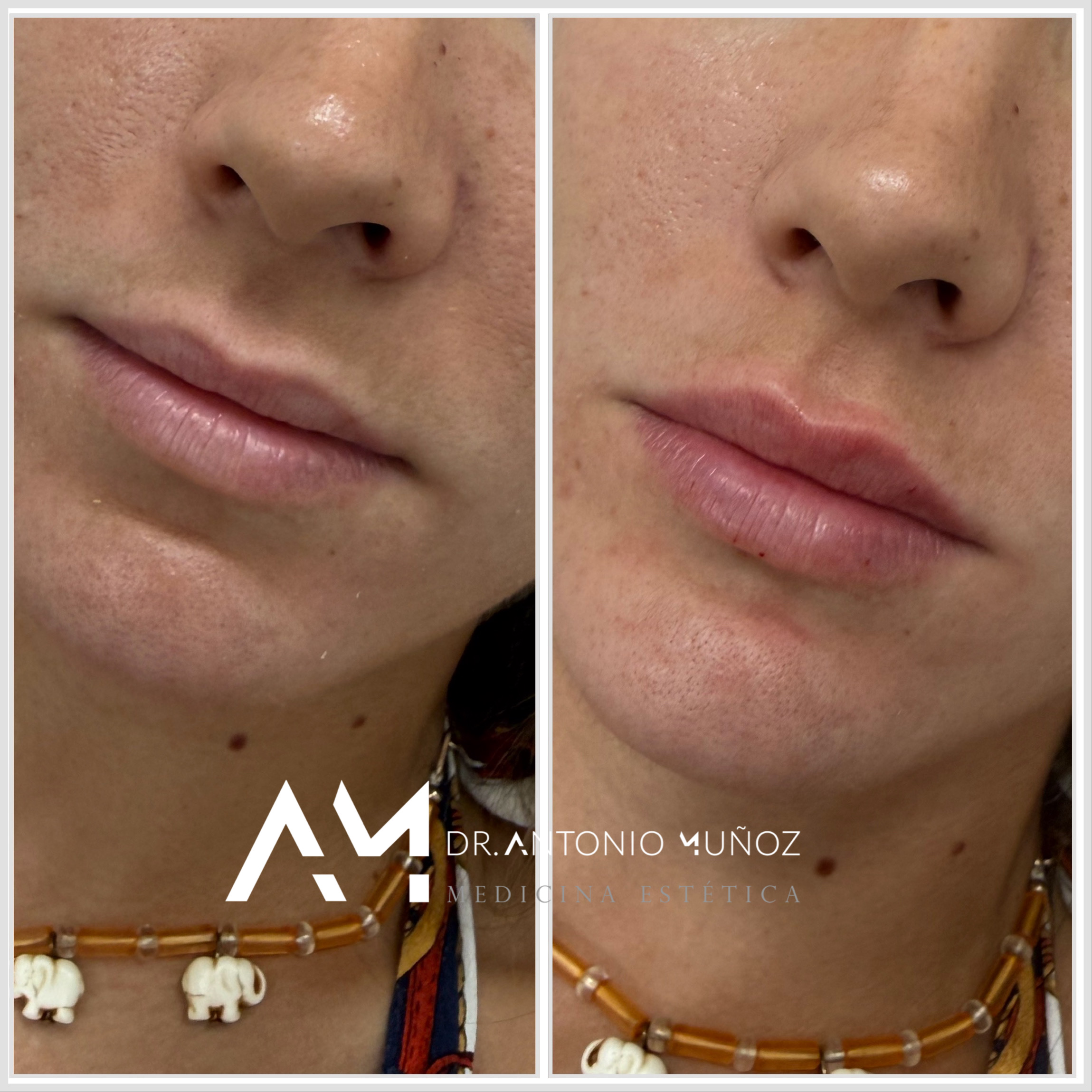 aumento de labios
