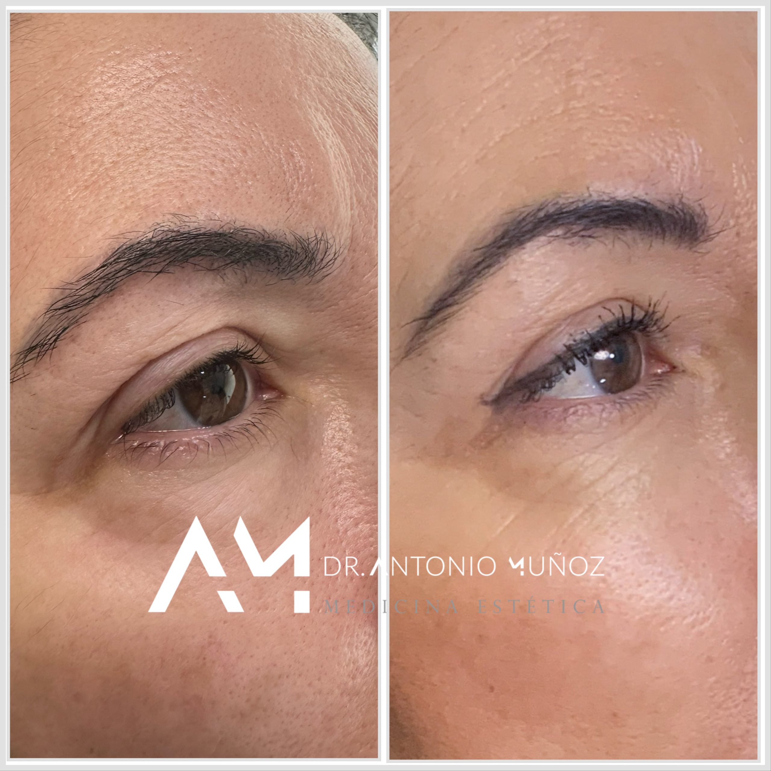 blefaroplastia sin cirugía