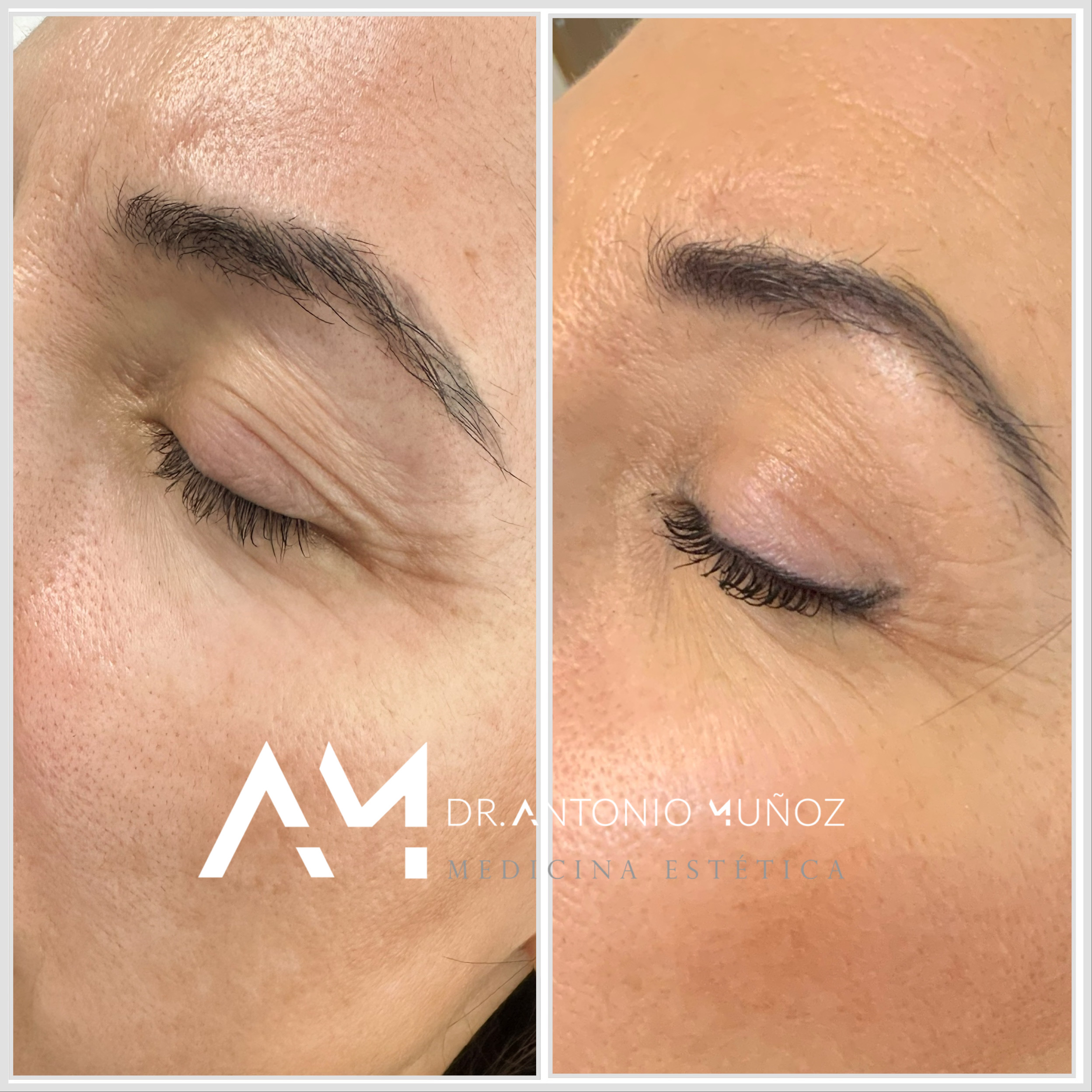 blefaroplastia sin cirugía