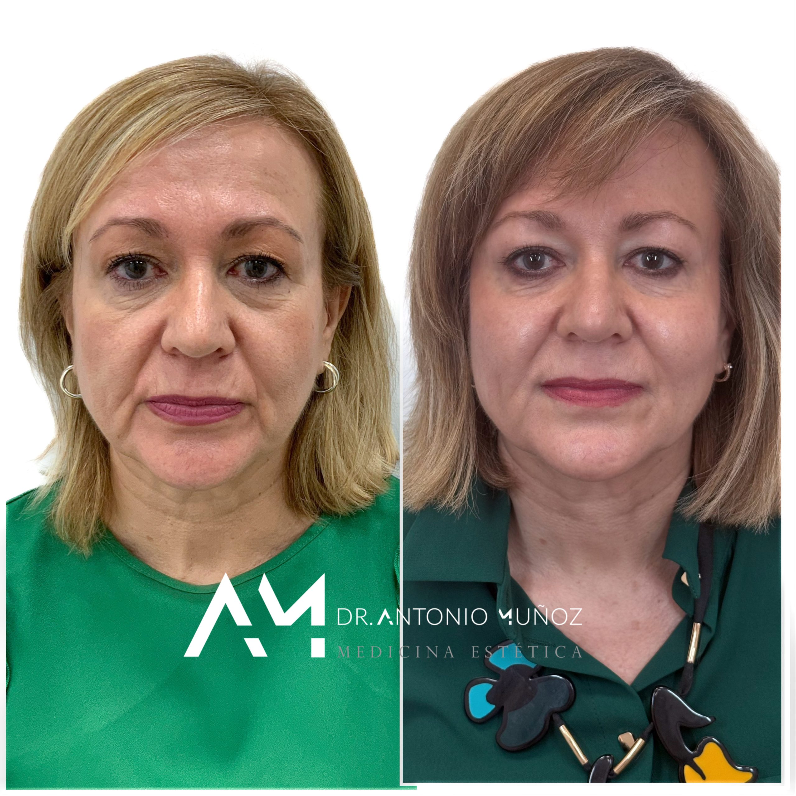 Full Face en Alicante