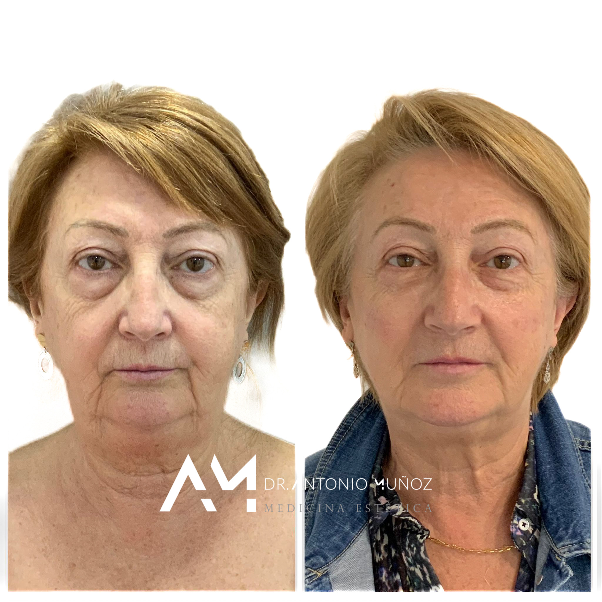 Full Face en Alicante