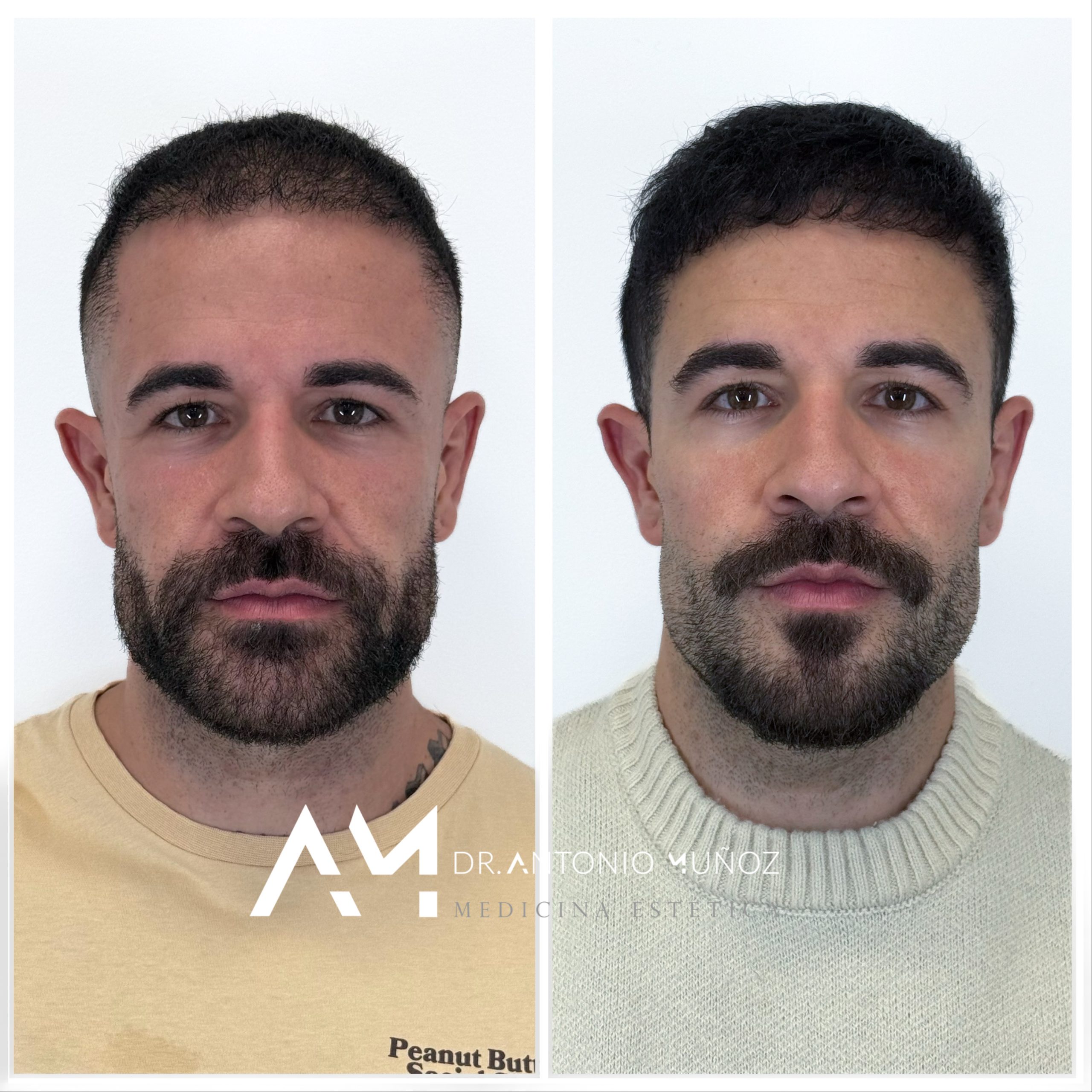 Full Face en Alicante