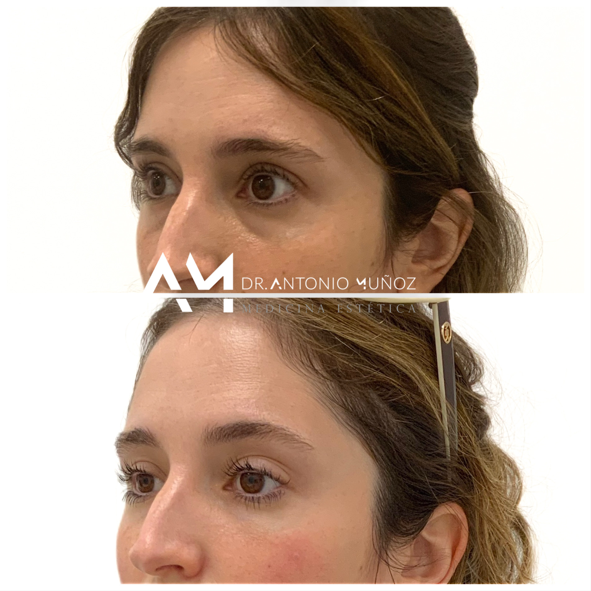 tratamiento de ojeras