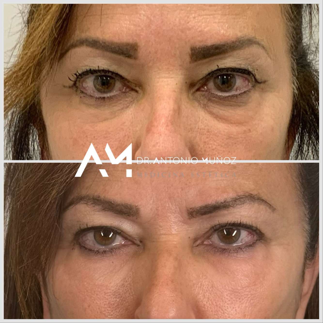 tratamiento de ojeras