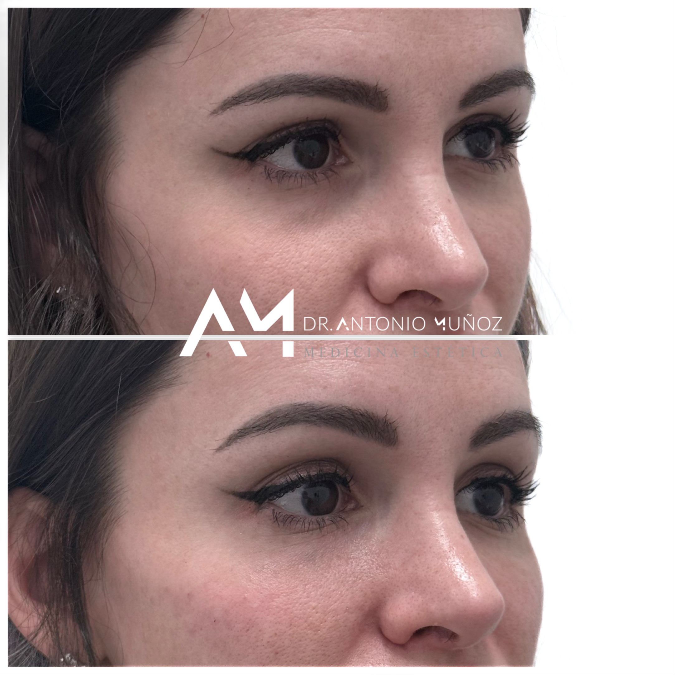 tratamiento de ojeras