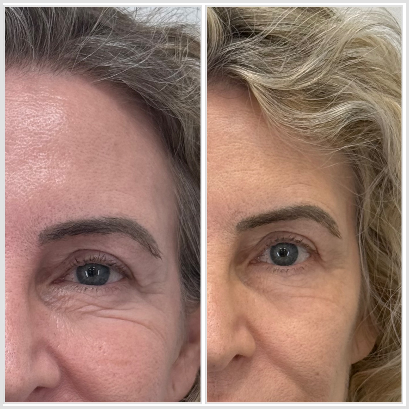 tratamiento de ojeras