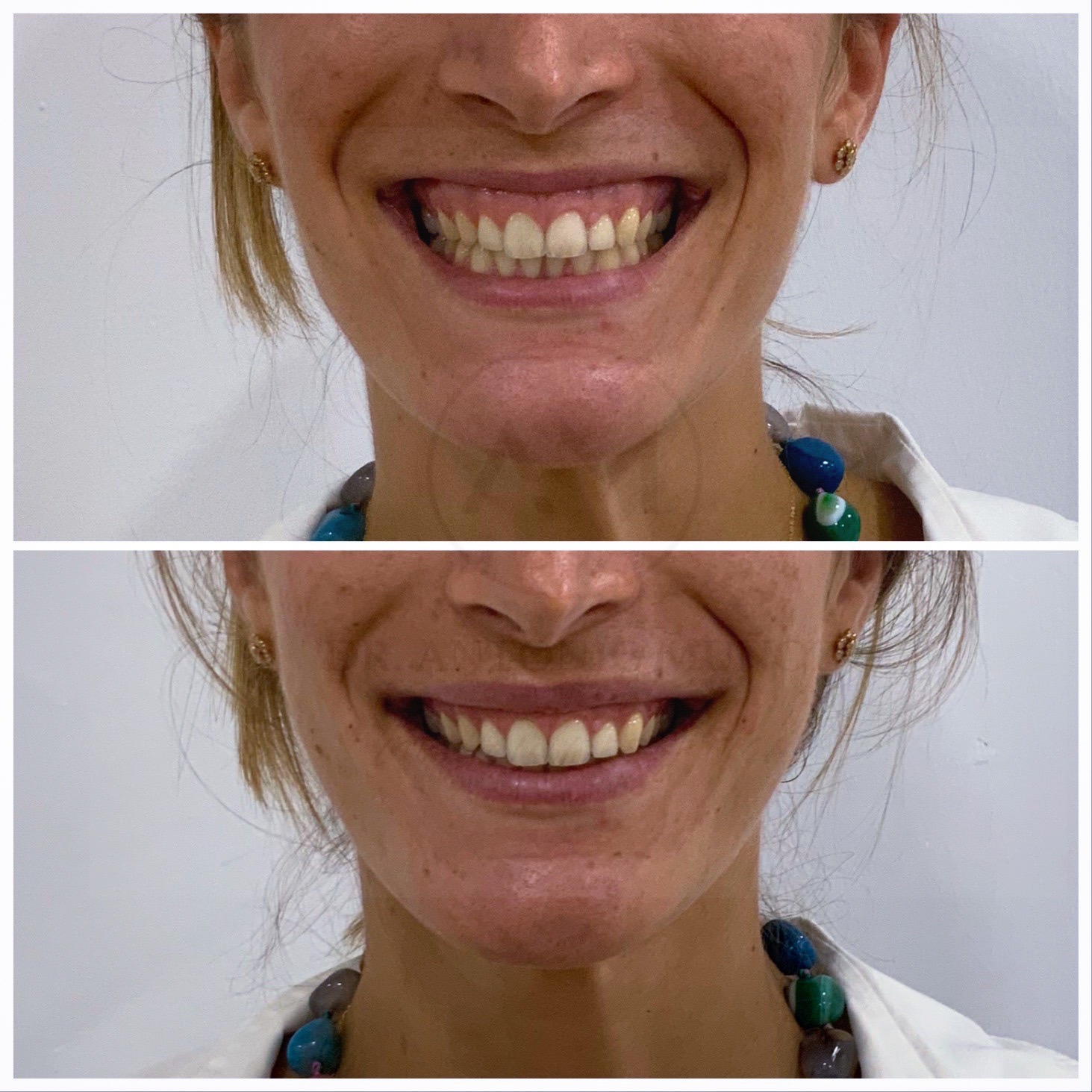 sonrisa gingival
