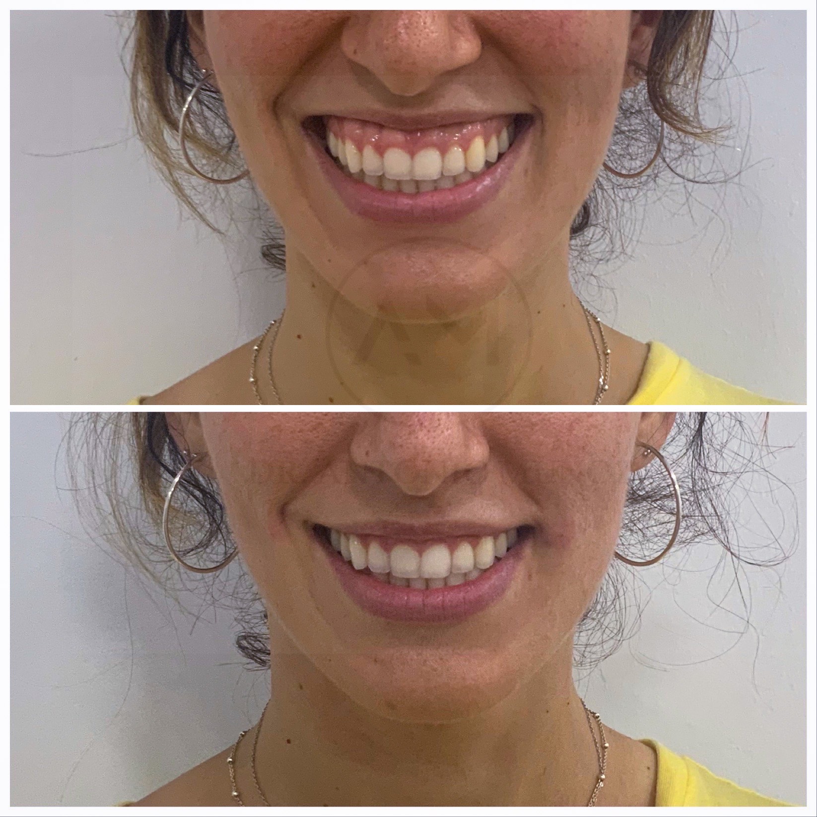 sonrisa gingival