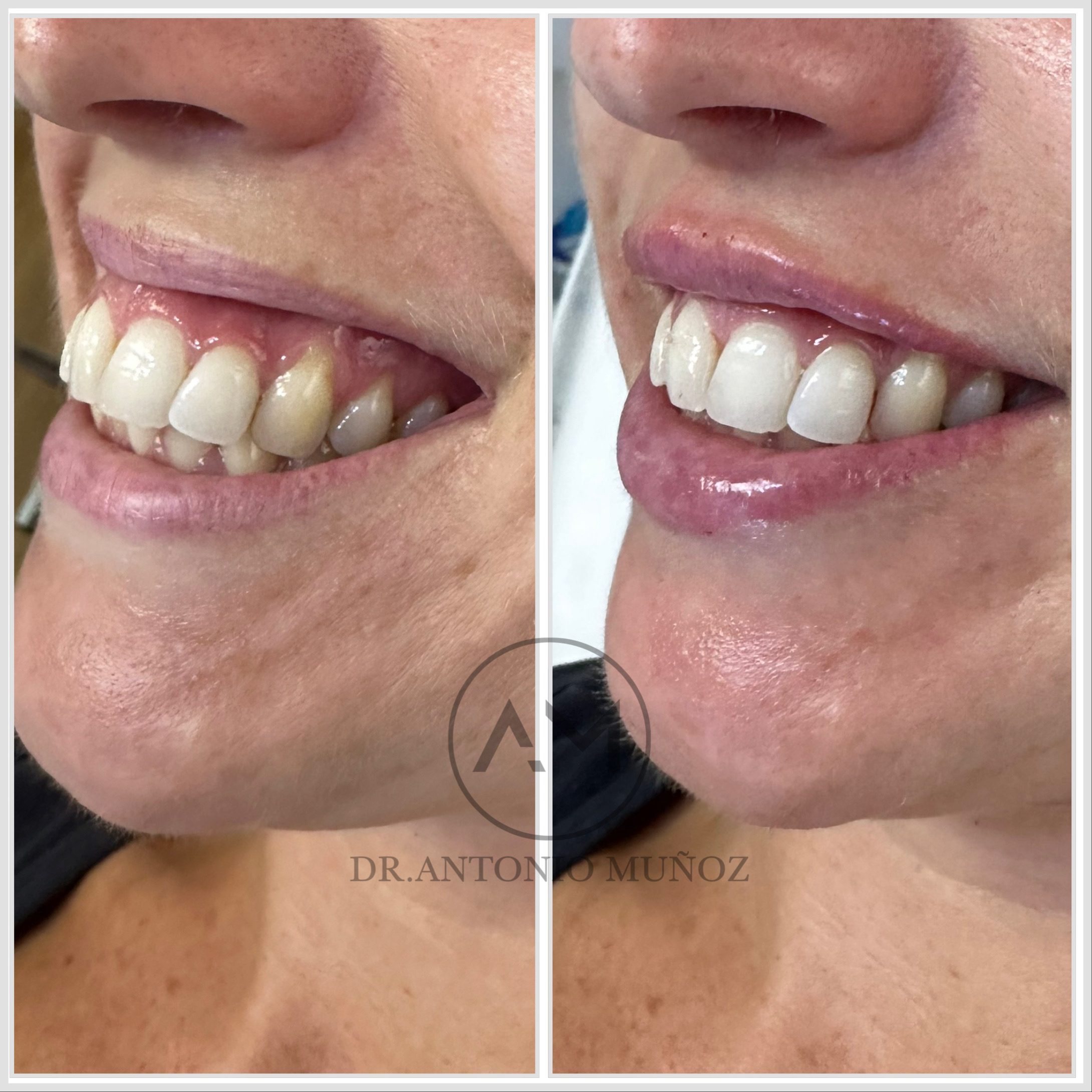 sonrisa gingival