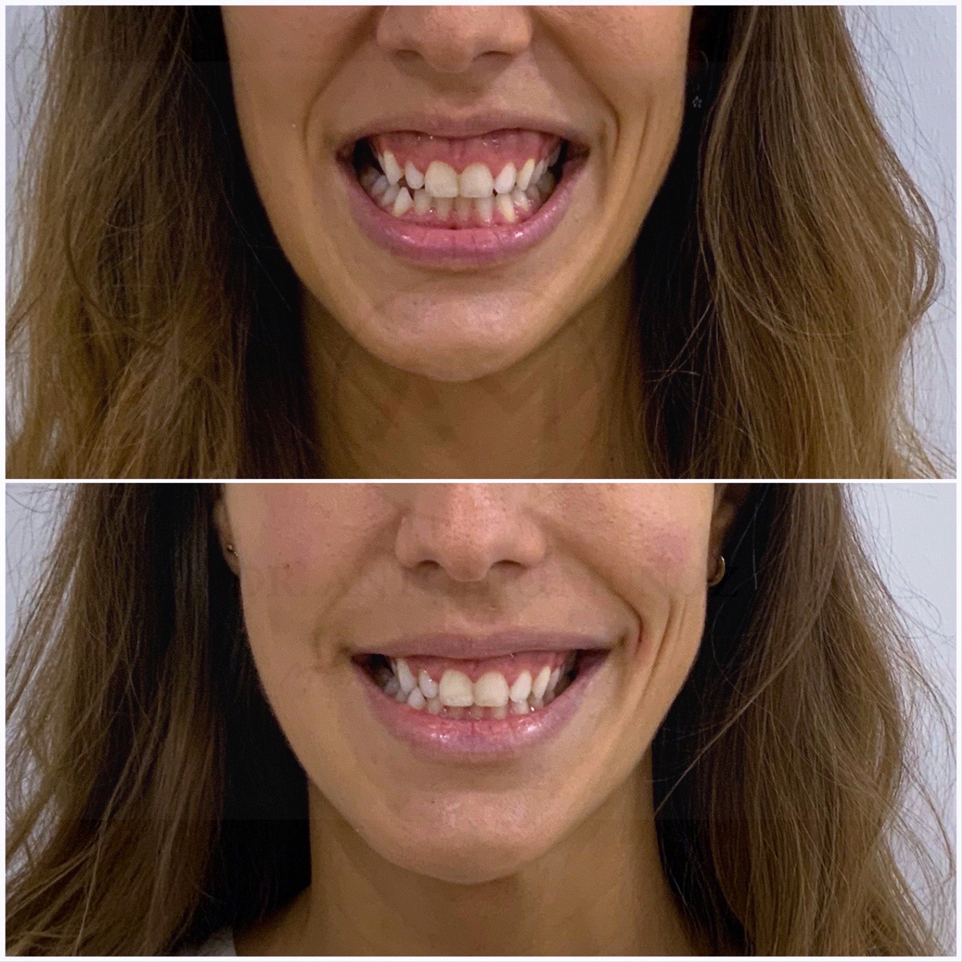 sonrisa gingival